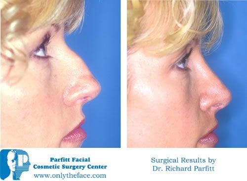 Rhinoplasty Madison WI