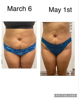 This client received 12 sessions of non invasive lipo 360. Book your consultation today.