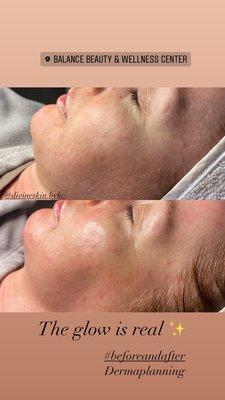 Dermaplane facial