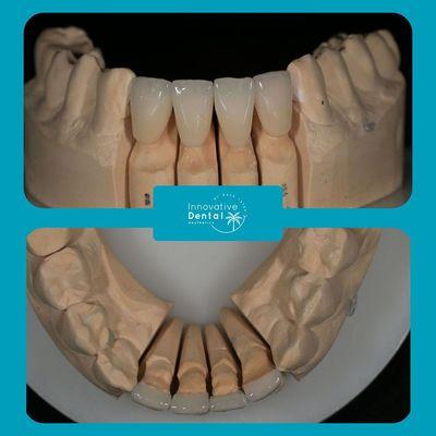 Experience comfort, durability, and a radiant smile with custom-made veneers. Book an appointment: 561-997-6622