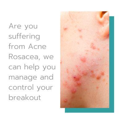 Suffering from Acne Rosacea we can help address and manage your breakout.