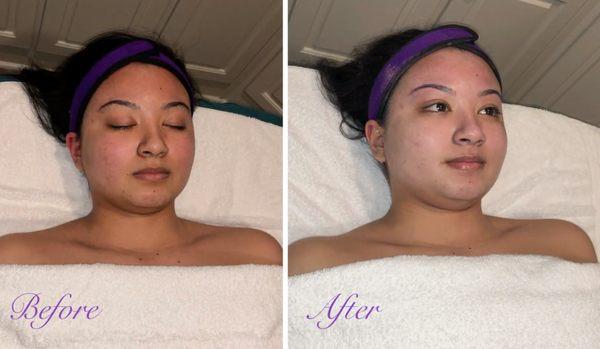 Oxygen Facial Results!