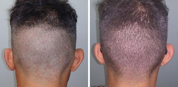 Here is a patient right before their procedure and exactly 1 week later. Notice how everything looks so natural.