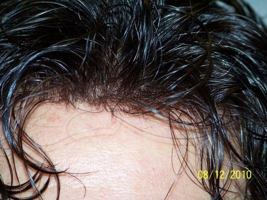 Front hairline of our hair systen. It looks like the hair grows naturally from your scalp.