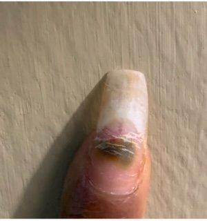 Nail fungus