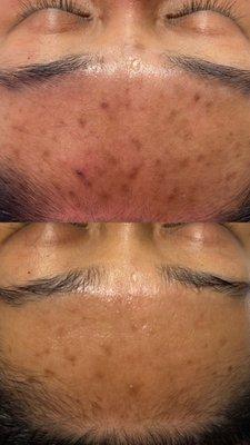 Hyperpigmentation before & after multiple treatments using HydroGlow & Dermaplaning