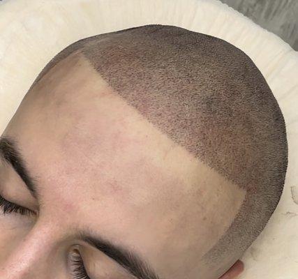 Scalp Micropigmentation - After