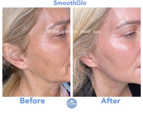 SmoothGlo Results at The Garden!