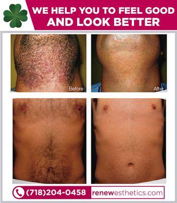 Gentle Laser Hair Removal for men