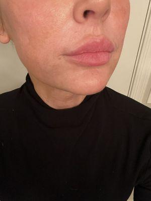 5 months post treatment with Matrix RF Microneedling, Ultraclear Erbium Laser and Juvederm Dermal Filler.