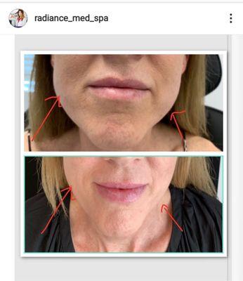 Botox in jaw(masseter muscle) to create facial slimming effect!