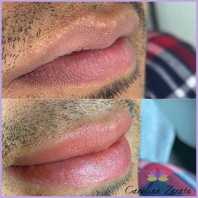 Lip blush neutralization 
$450