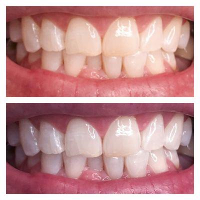 SmileLabs Teeth Whitening