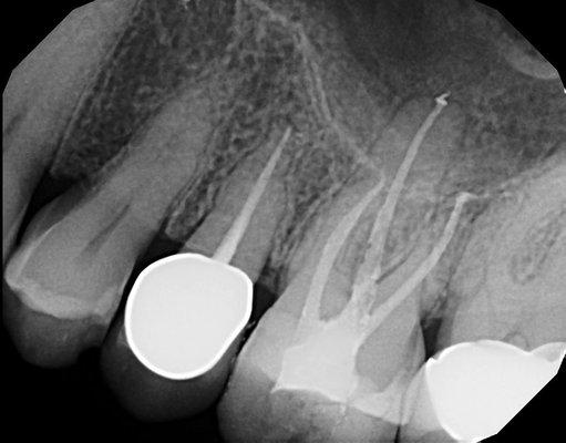 Root Canal or Endodontic treatment doesn't have to be painful.