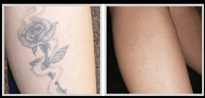 Laser Tattoo Removal