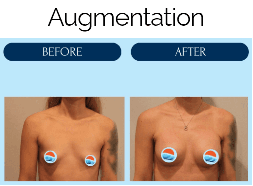 Before and after breast augmentation!