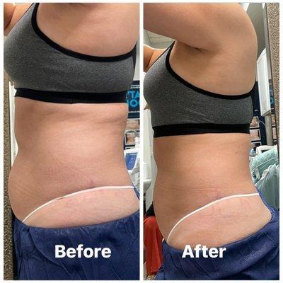 Before & After 1 session of CoolSculpting