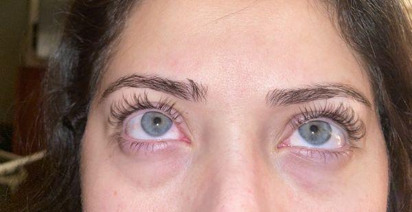 post lash lift: swollen eyes, scarred,blocked tear ducts  blurry vision, painful streaks in eyes.