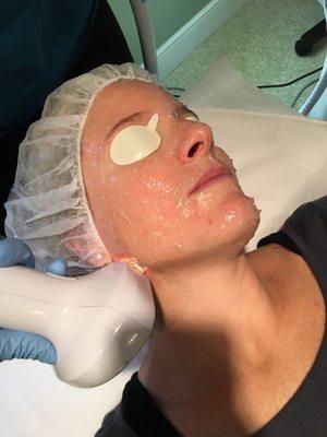 Erin is performing an IPL Photofacial to remove brown spots and redness