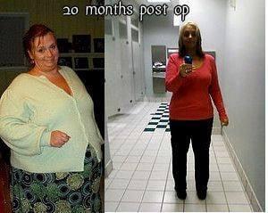 Before and after pics of patient at Bariatric Specialists of NC.