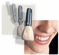 Esthetic Implants