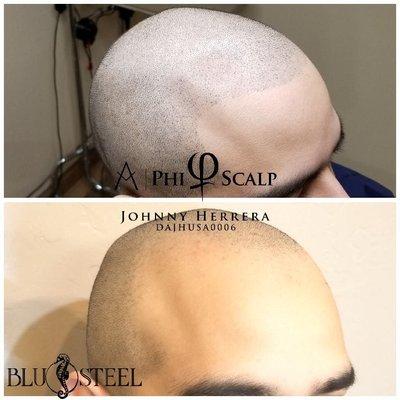 Scalp Micropigmentation (SMP)