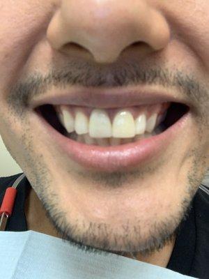 Make sure you make work with them to match your teeth color and anatomy or else this will happen to you.