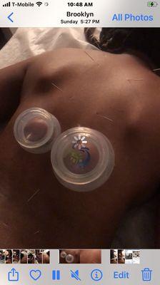 Acupuncture w Chinese Cupping at XPRESS THERAPY