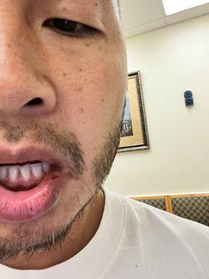 Dentist dropped her drill and cut my lip !!!