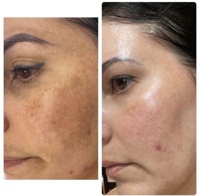 Skin pigmentation treatment - melasma