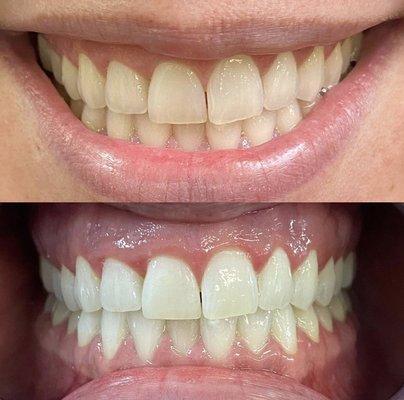 We offer Teeth Whitening Services. 60 mins to a great smile!