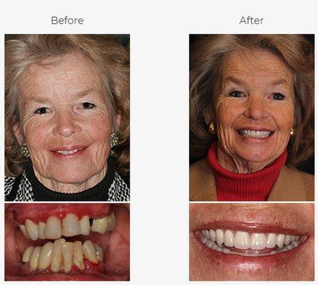 After extraction, we provided her with the Denture Fountain of Youth®.