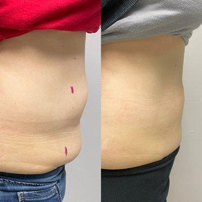 Before and after 4 Bodysculpting Treatments