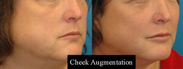 Cheek Augmentation by Dr. Richard Parfitt