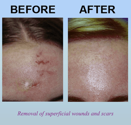 Removal of superficial wounds and scars