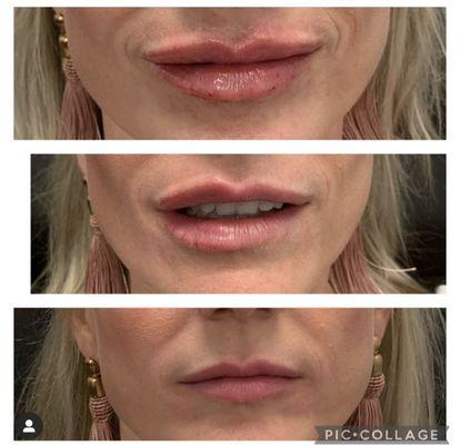 Lip filler to help plump and hydrate.