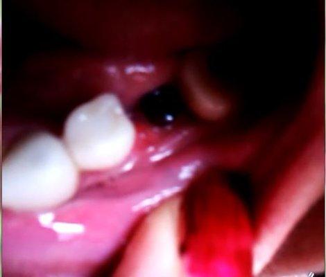 Ulcer below n20 implant