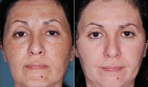 Medical Grade Chemical Peel