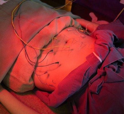 Electric-acupuncture for anti-cellulite