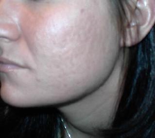 After Acne Photo