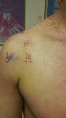 Labrum reconstruction. After getting staples taken out.