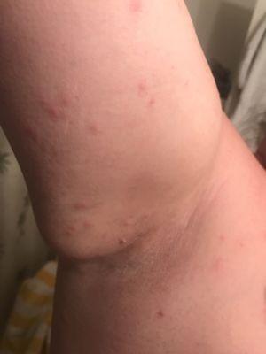 Literally hundreds of bites.Was told they don't have a problem that spray for bed bugs weekly, even have special mattress covers for bed bug