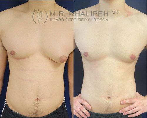 Unilateral Gynecomastia Surgery