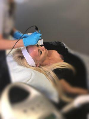 MicroNeedling