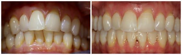 Invisalign Before and After!