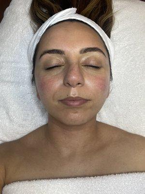 After Hydra-facial