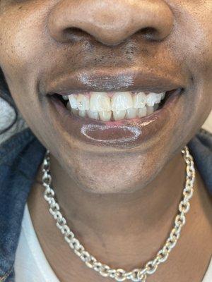 Results after a 30 minute teeth whitening session