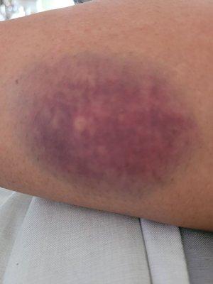 Bruise from needle