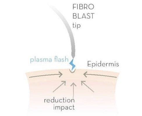 How Plasma Fibroblast works. Non invasive skin tightening!