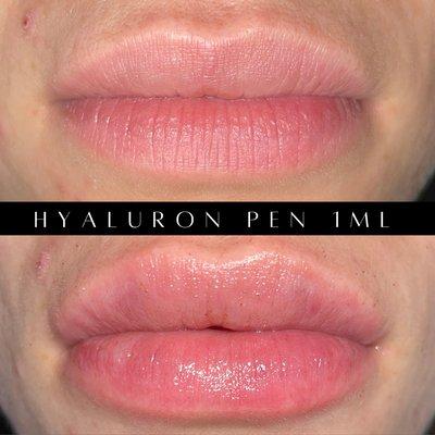 Hyaluron Pen